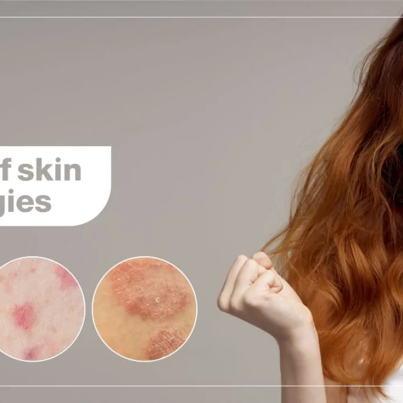 Skin Allergies: Five most common types